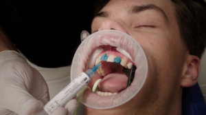 FIT Veneer