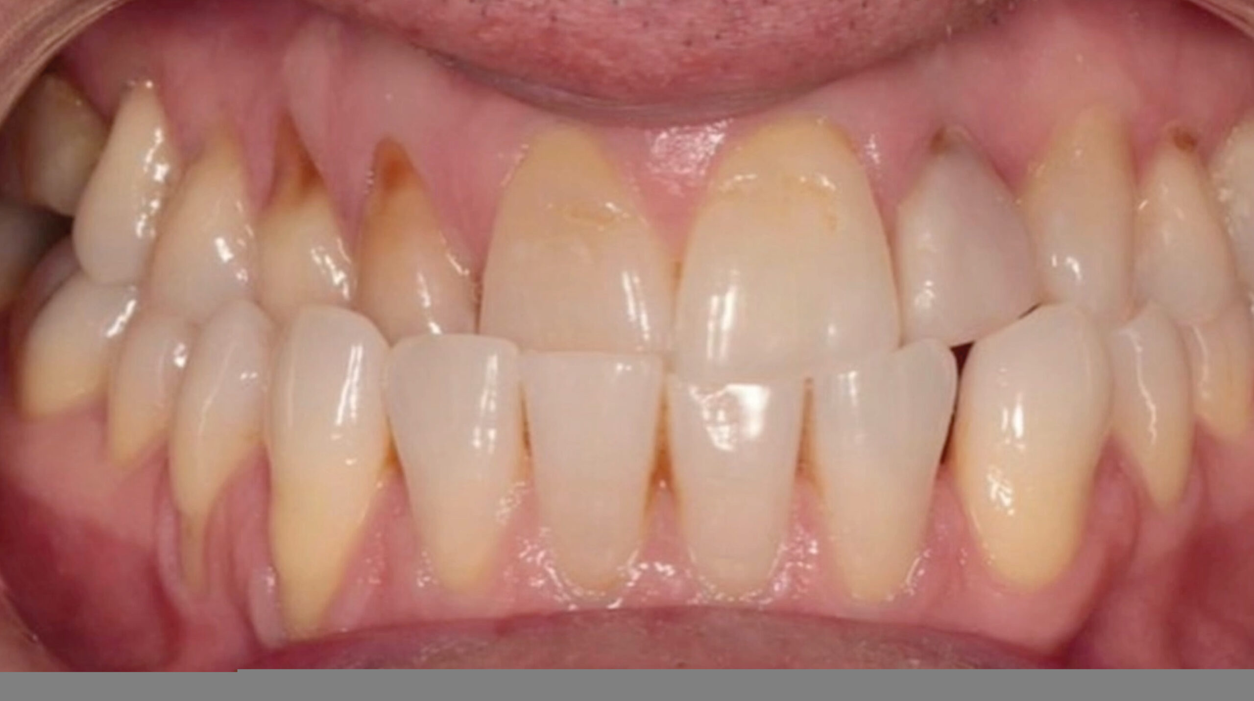 Second Day_TrioClear Align and Restore_Slider_8