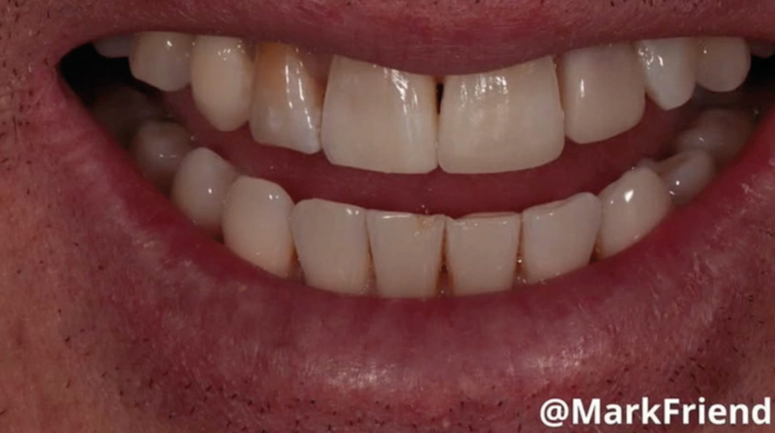 Second Day_TrioClear Align and Restore_Slider_9