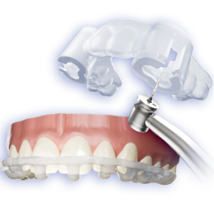 IPS emax Guided Veneers Treatment by Trioclear 360